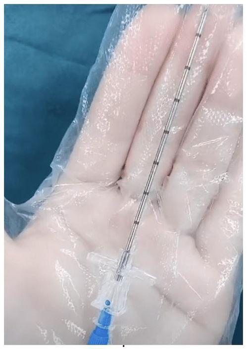 剖腹产打麻药视频,安全无痛的分娩体验